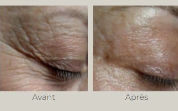 Selenia - Scarlett The Beauty Centre Pro - InDeep avant - après